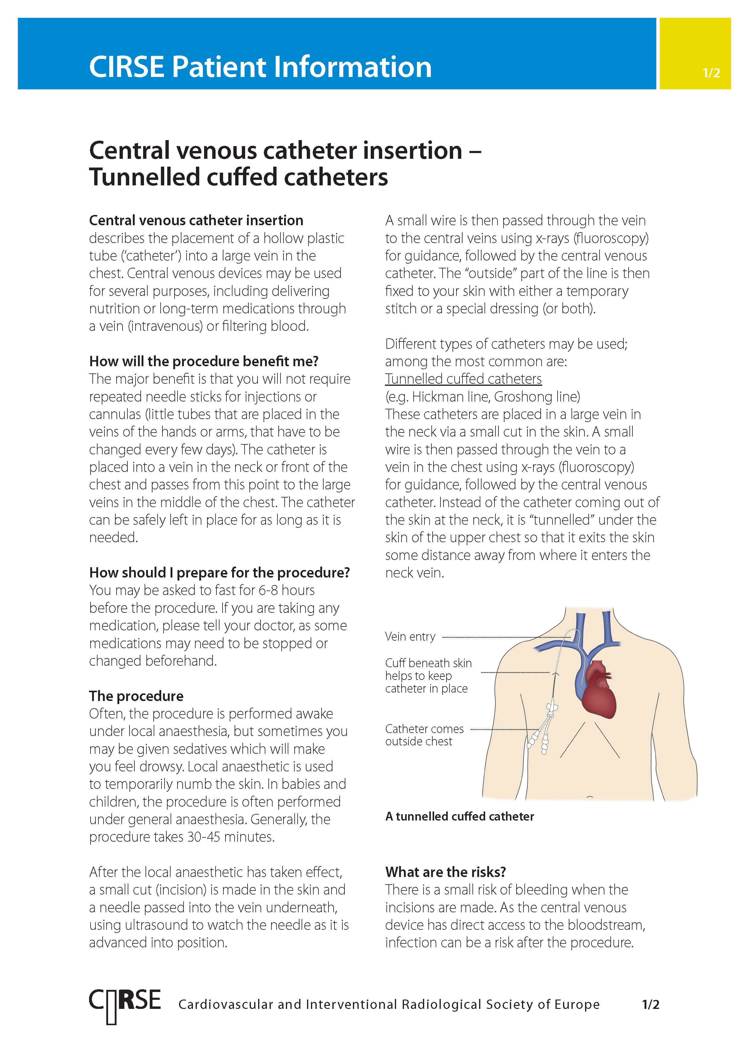 Central venous catheter insertion - tunnelled cuffed catheters