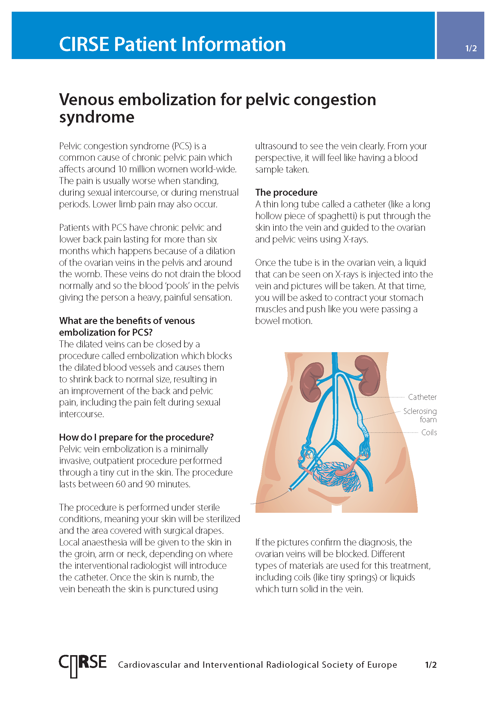 Venous embolization for pelvic congestion syndrome